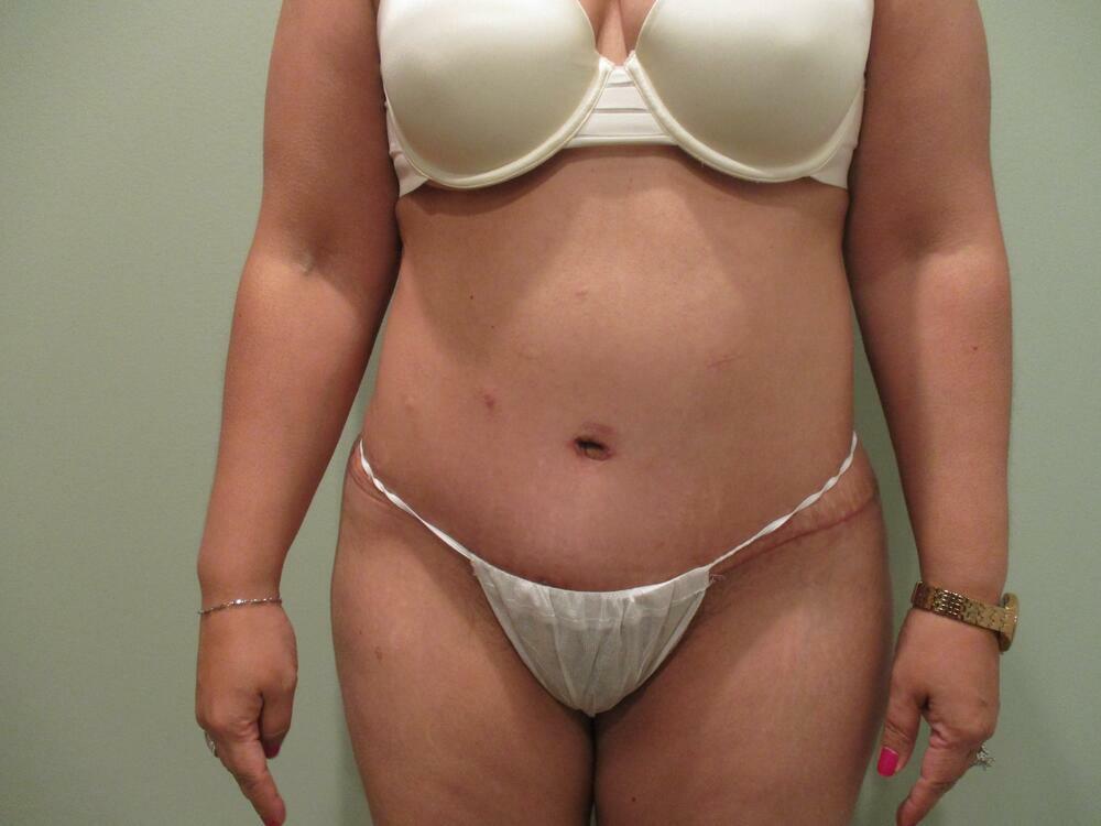 Tummy Tuck Before & After