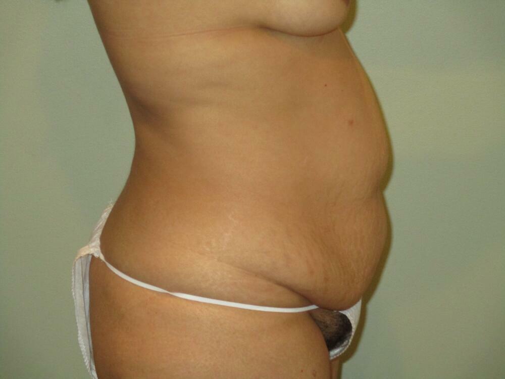 Tummy Tuck Before & After