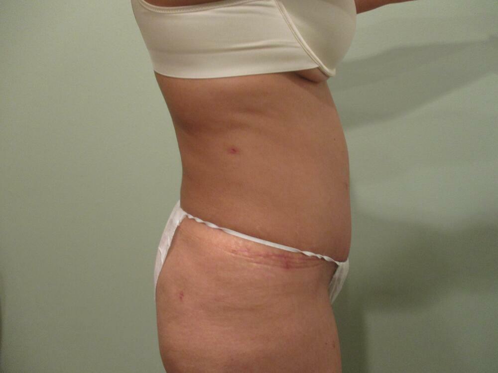 Tummy Tuck Before & After