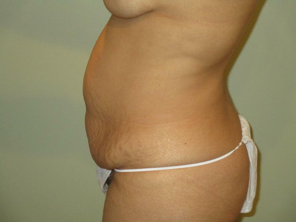 Tummy Tuck Before & After