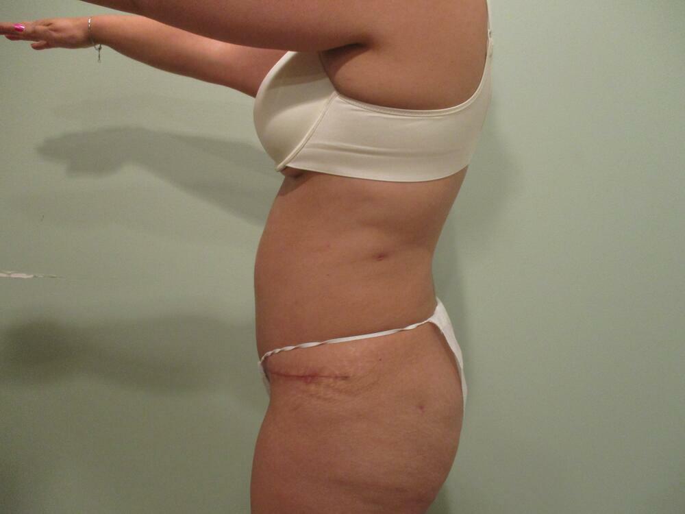 Tummy Tuck Before & After