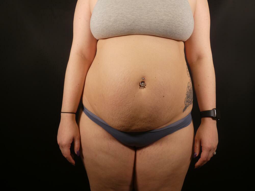 Tummy Tuck Before & After