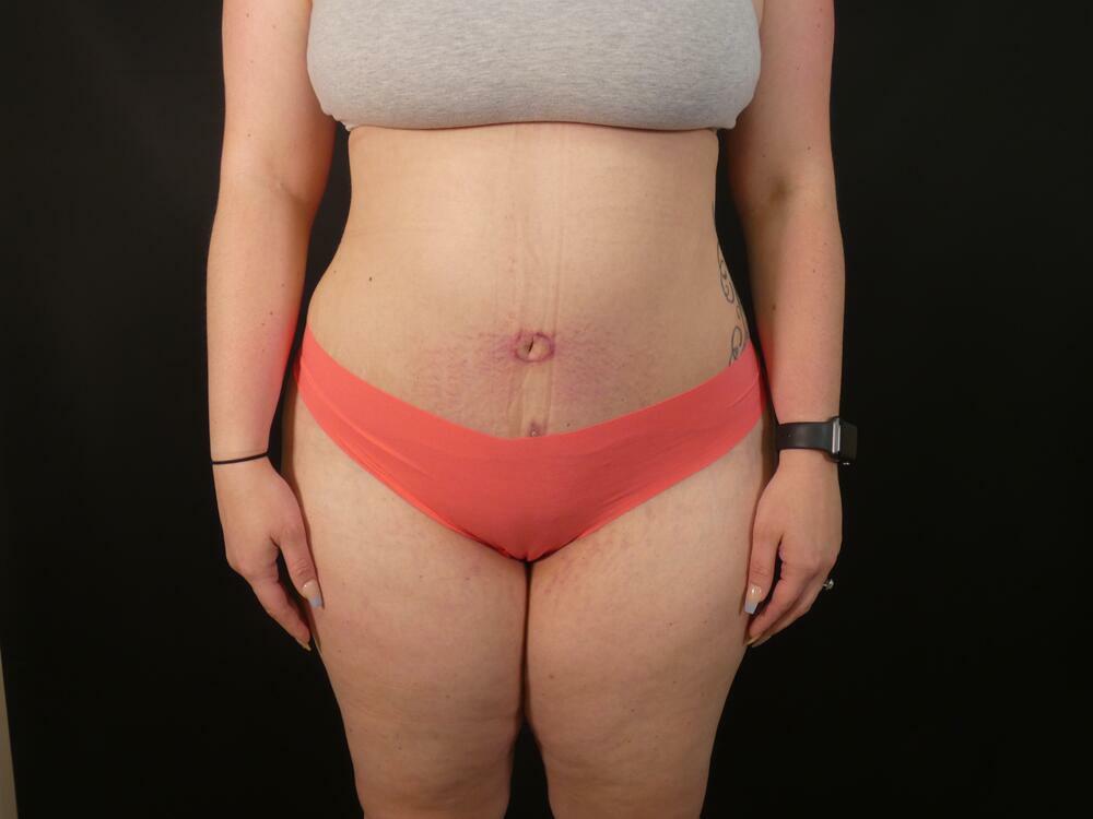 Tummy Tuck Before & After