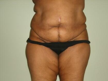 Tummy Tuck Before & After