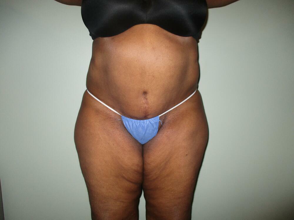 Tummy Tuck Before & After