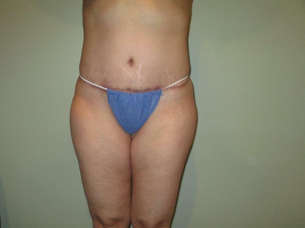 Tummy Tuck Before & After