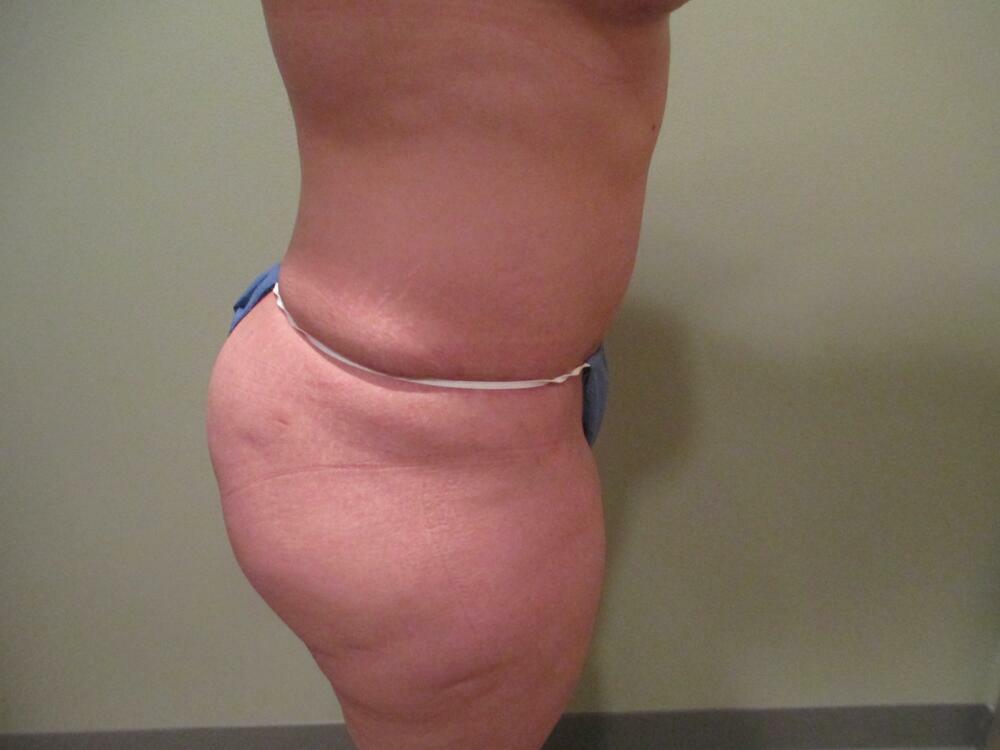 Tummy Tuck Before & After