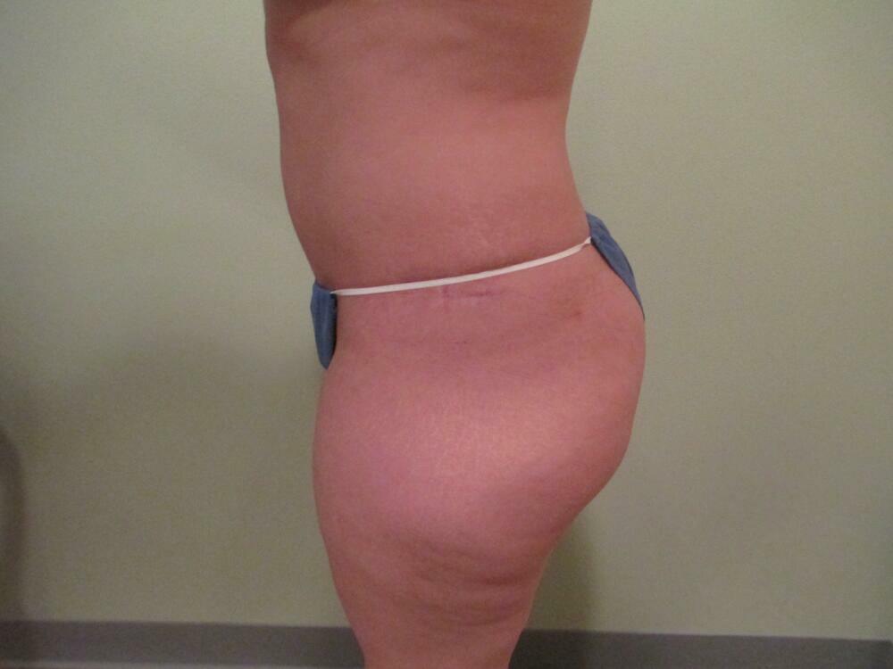 Tummy Tuck Before & After