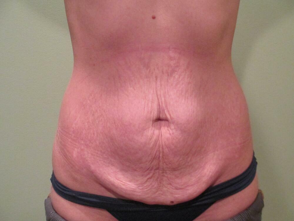 Tummy Tuck Before & After