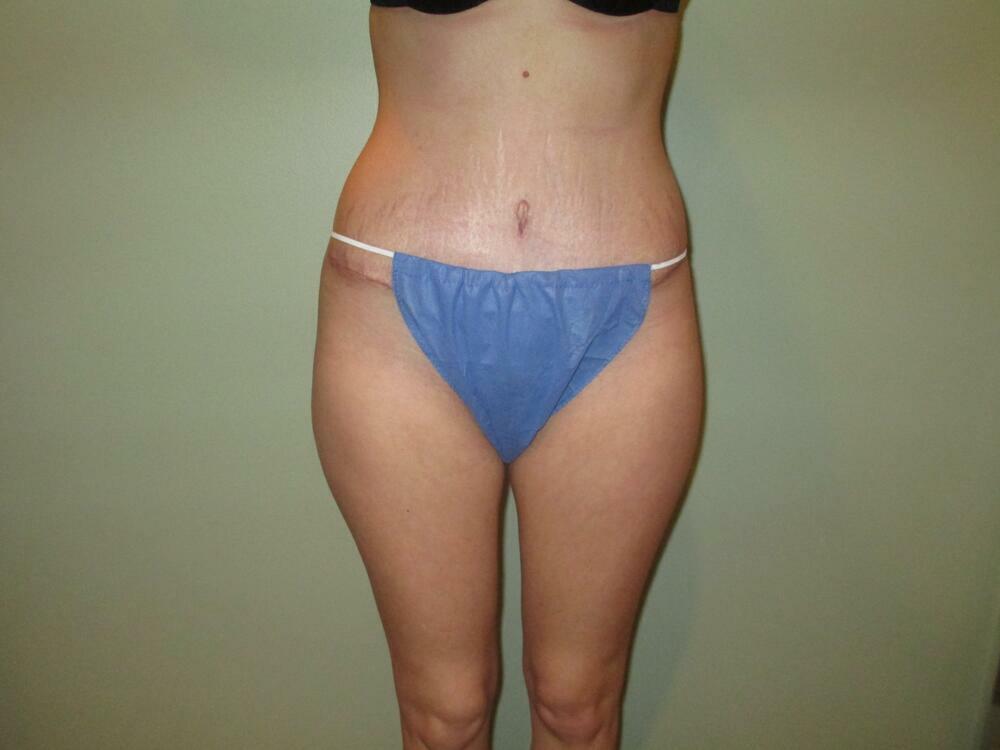 Tummy Tuck Before & After