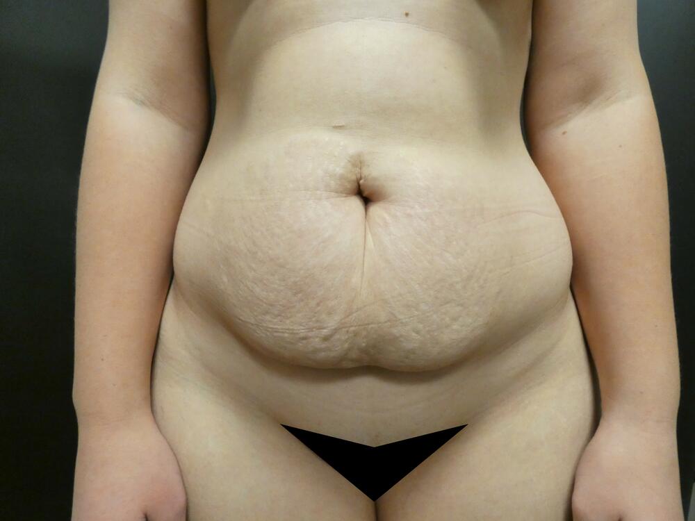 Tummy Tuck Before & After