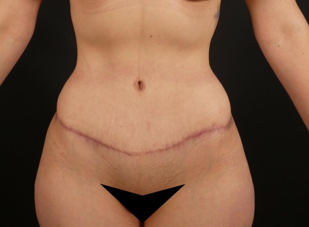 Tummy Tuck Before & After