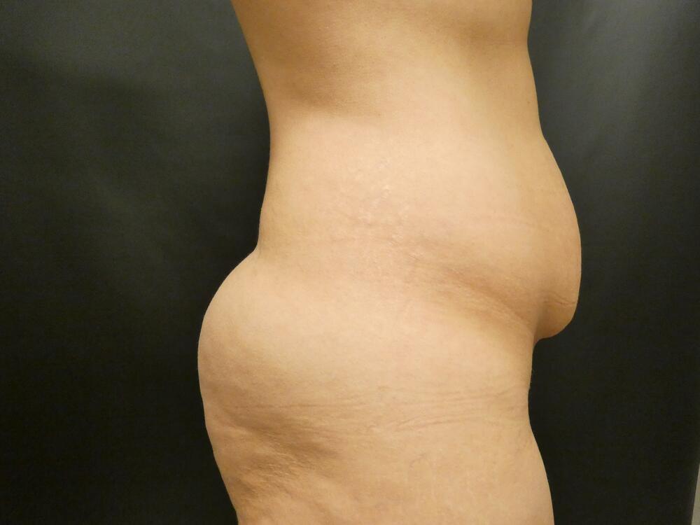 Tummy Tuck Before & After