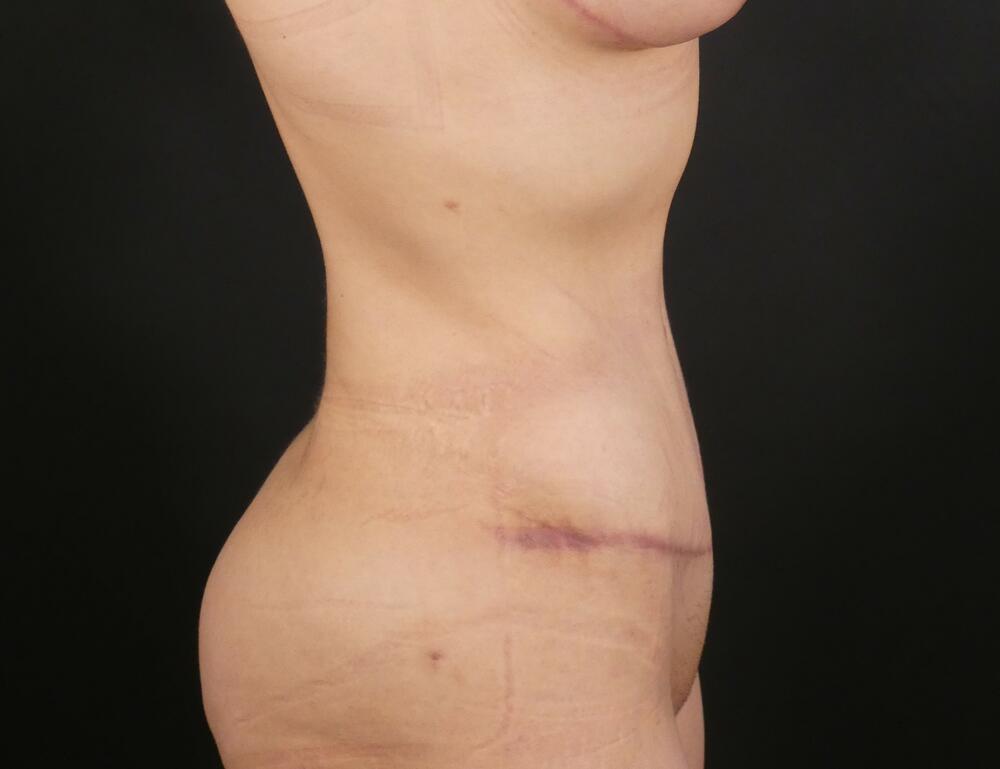 Tummy Tuck Before & After