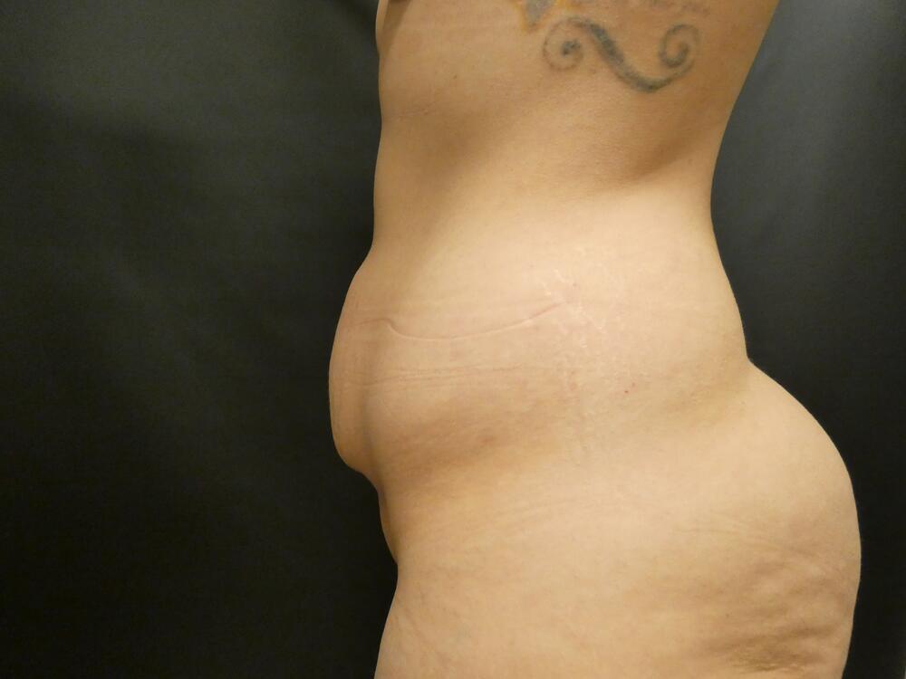 Tummy Tuck Before & After