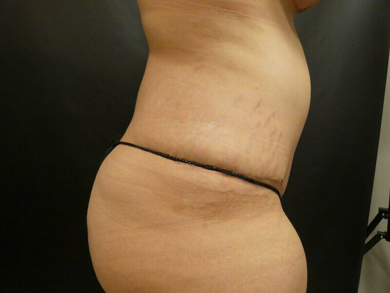 Tummy Tuck Before & After