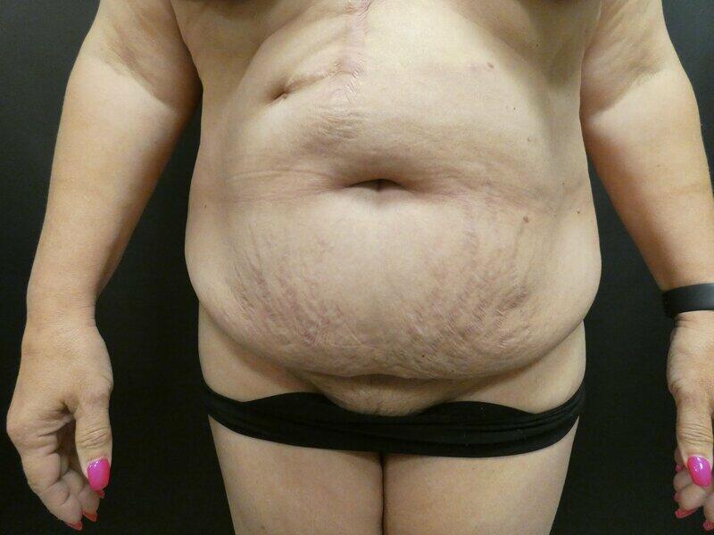 Tummy Tuck Before & After