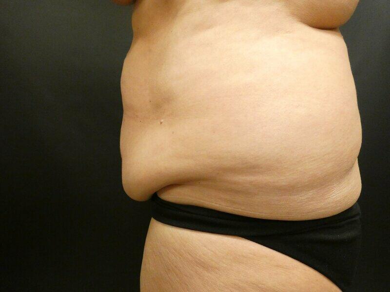 Tummy Tuck Before & After