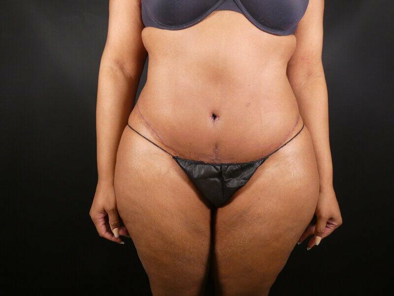 Tummy Tuck Before & After