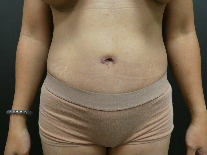 Tummy Tuck Before & After