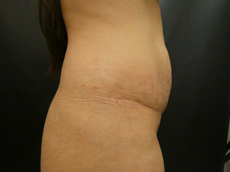 Tummy Tuck Before & After