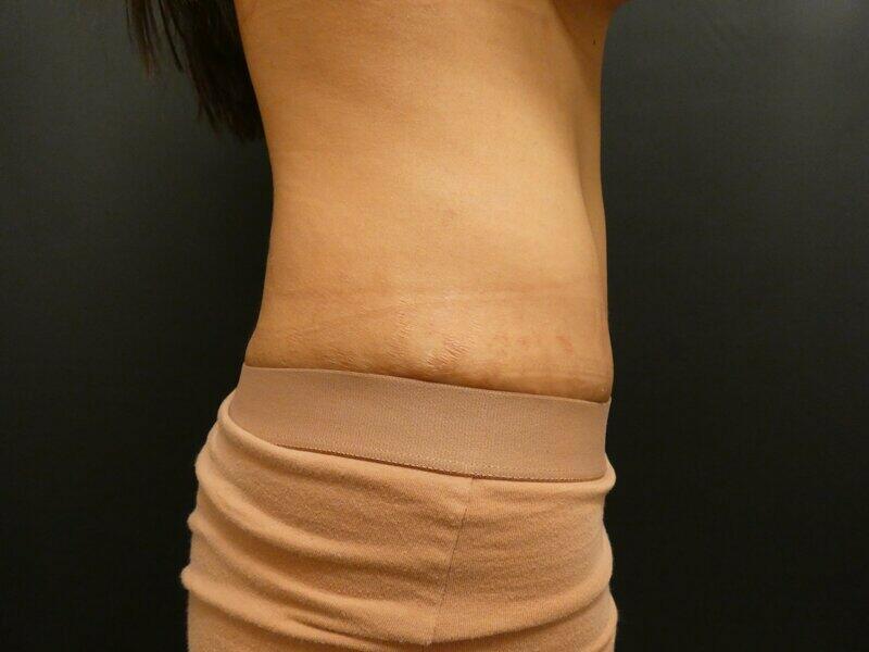 Tummy Tuck Before & After