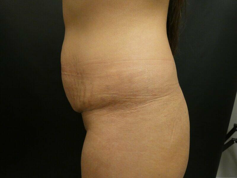 Tummy Tuck Before & After