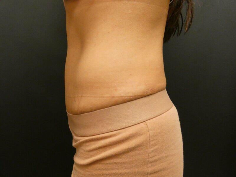 Tummy Tuck Before & After