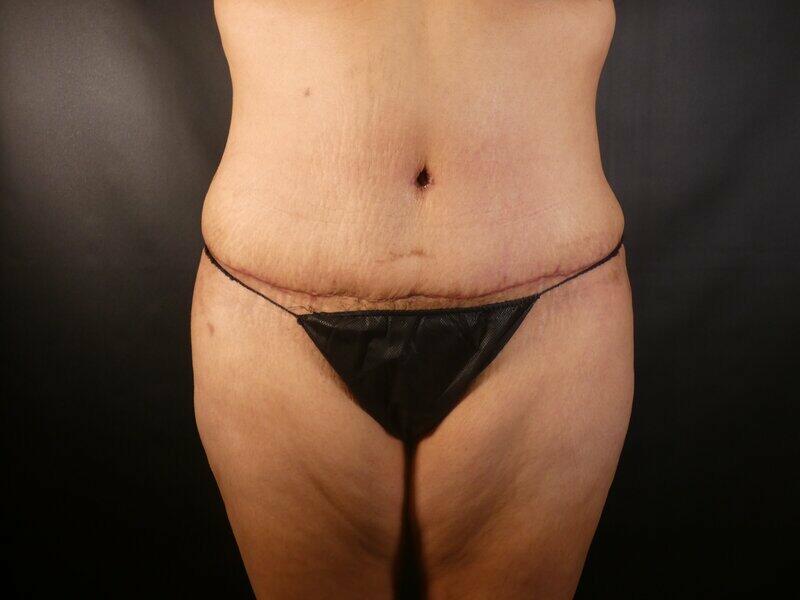 Tummy Tuck Before & After