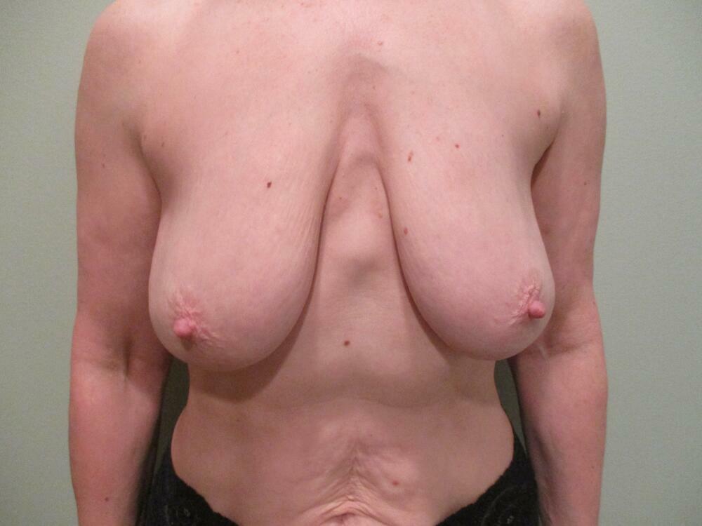 Breast Augmentation with Lift Before & After