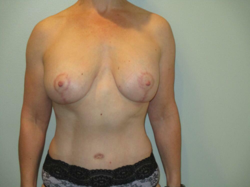 Breast Augmentation with Lift Before & After