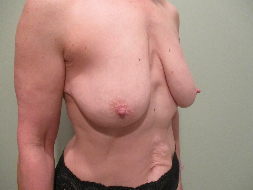 Breast Augmentation with Lift Before & After