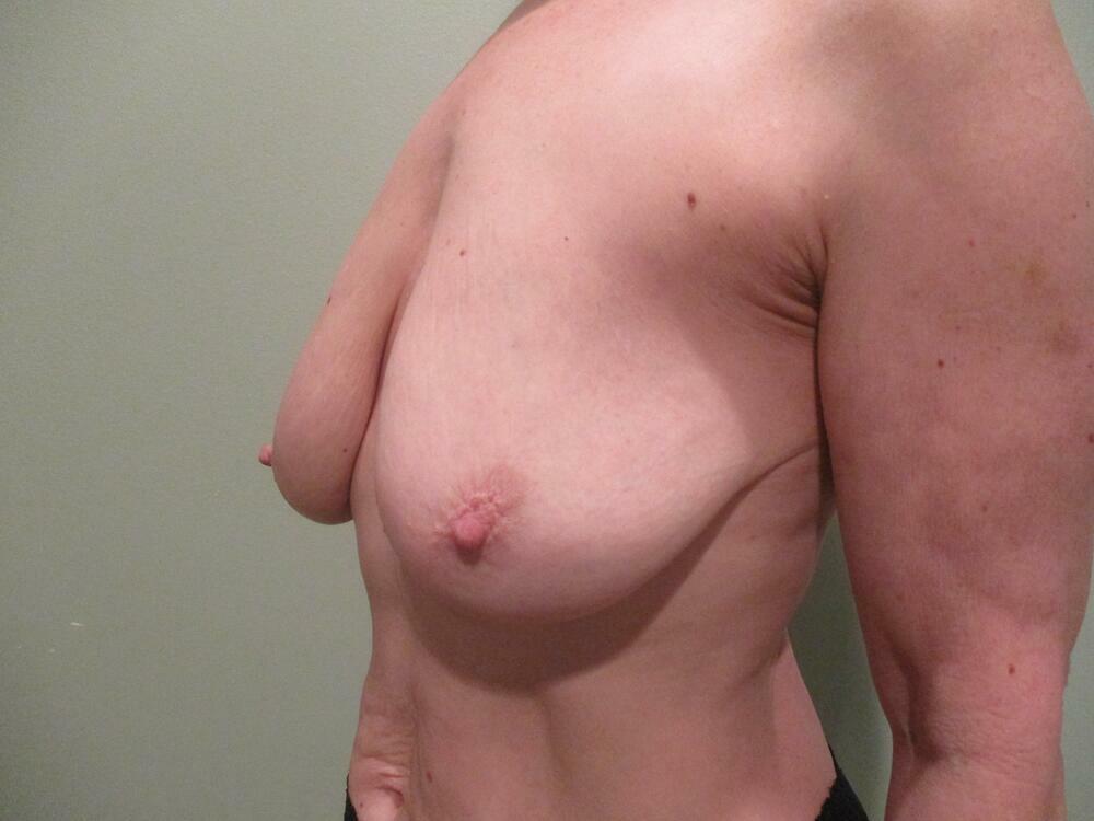Breast Augmentation with Lift Before & After