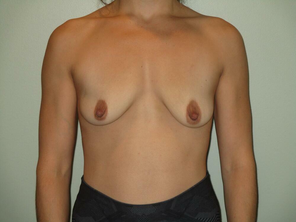 Breast Augmentation with Lift Before & After