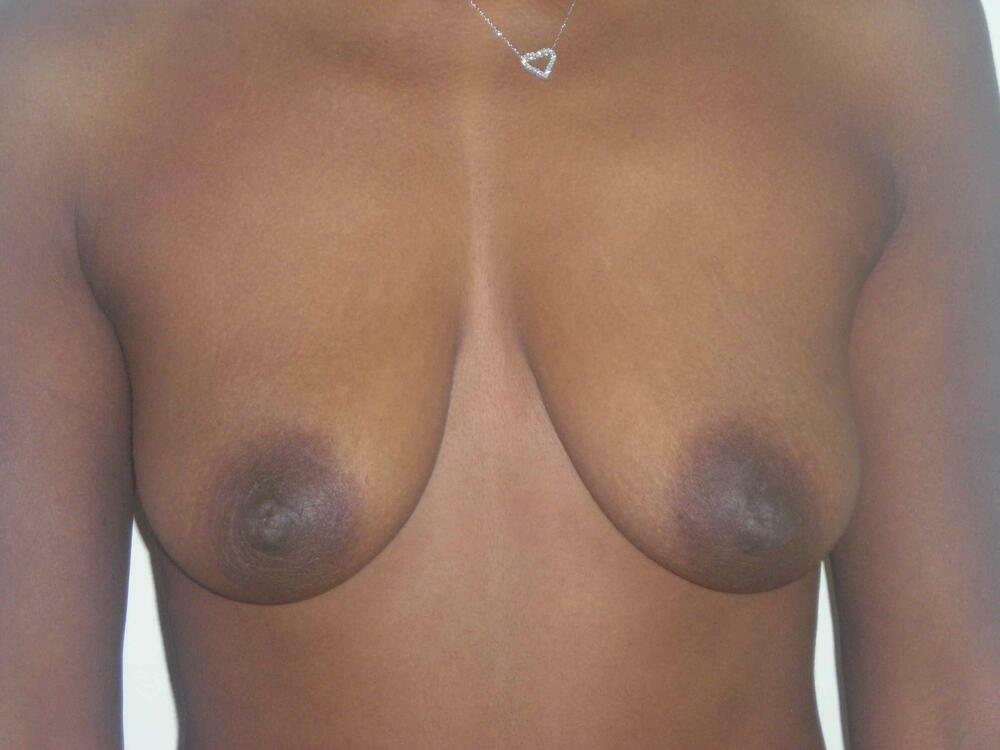 Breast Augmentation with Lift Before & After