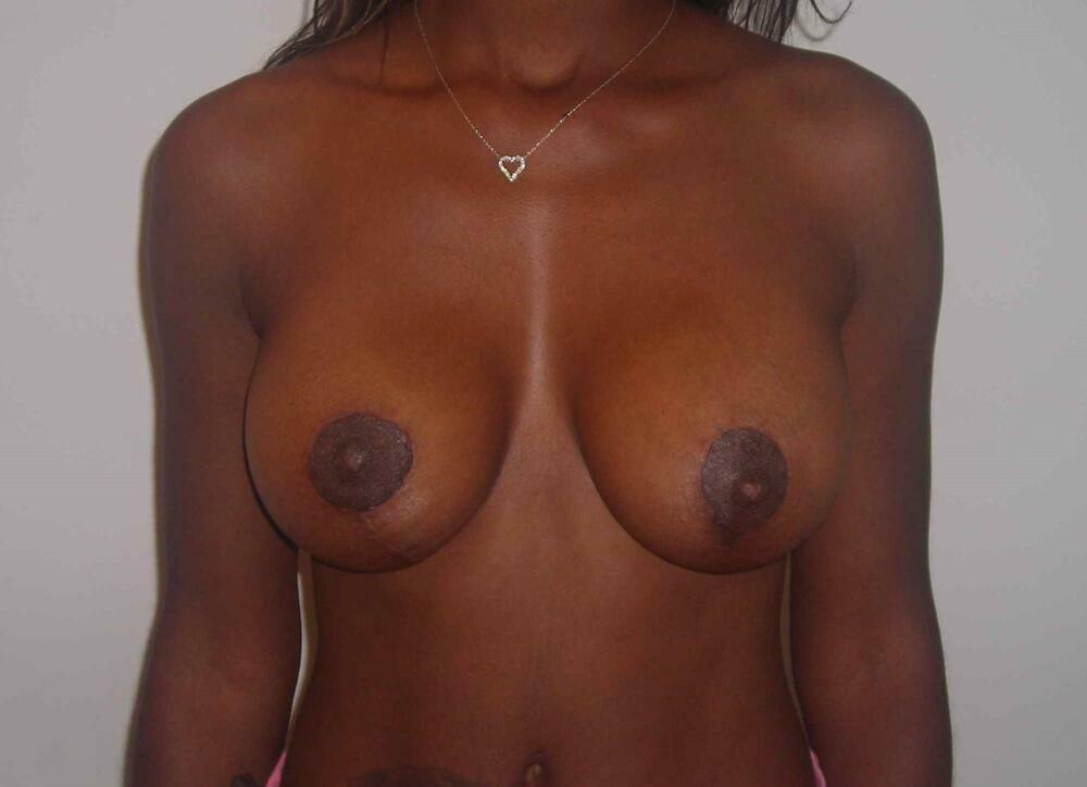 Breast Augmentation with Lift Before & After