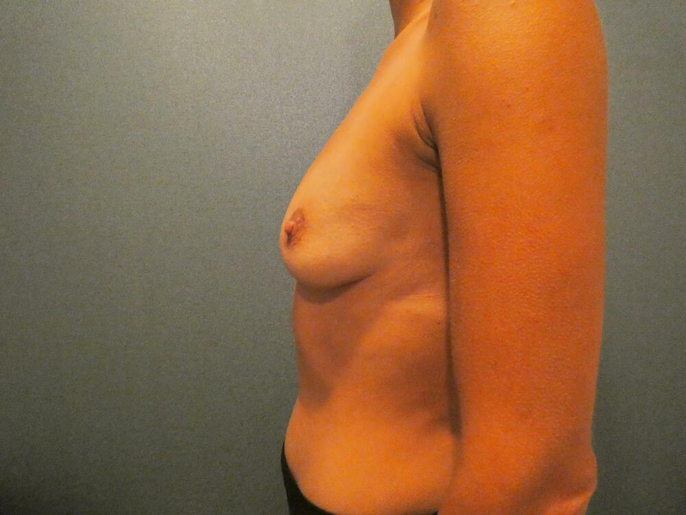 Breast Augmentation with Lift Before & After