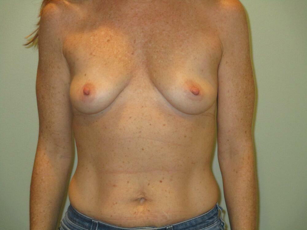 Breast Augmentation with Lift Before & After