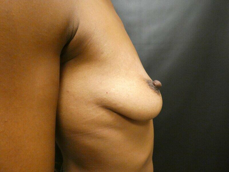 Breast Augmentation with Lift Before & After