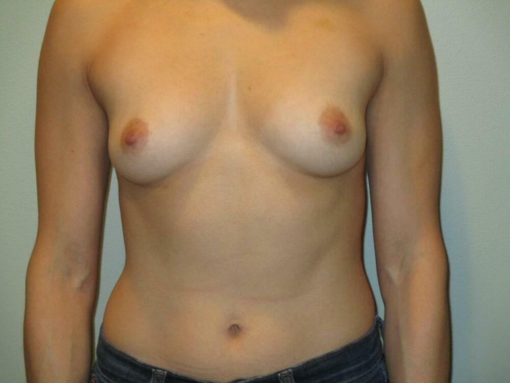 Breast Augmentation Before & After