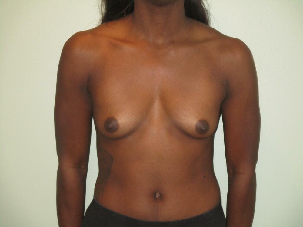 Breast Augmentation Before & After
