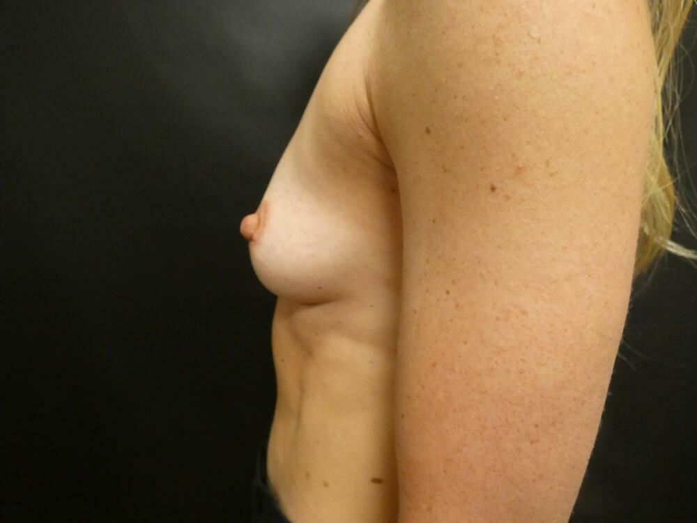 Breast Augmentation Before & After