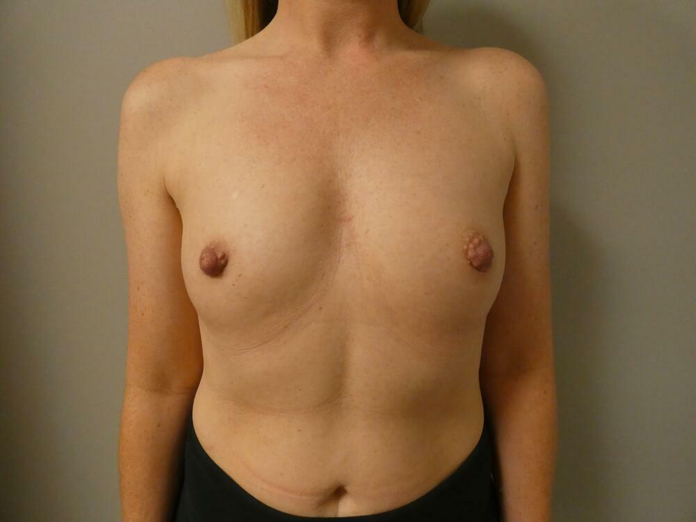 Breast Augmentation Before & After