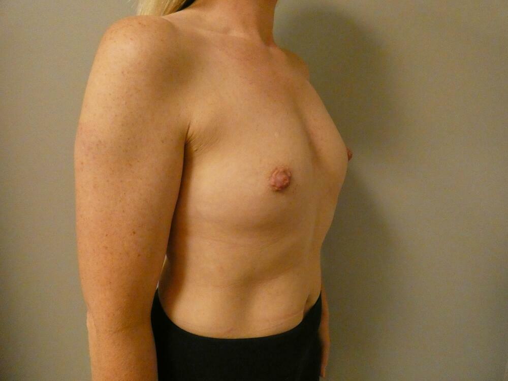 Breast Augmentation Before & After