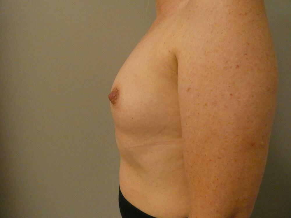 Breast Augmentation Before & After