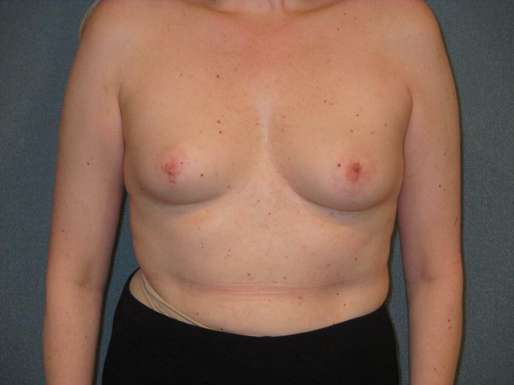 Breast Augmentation Before & After