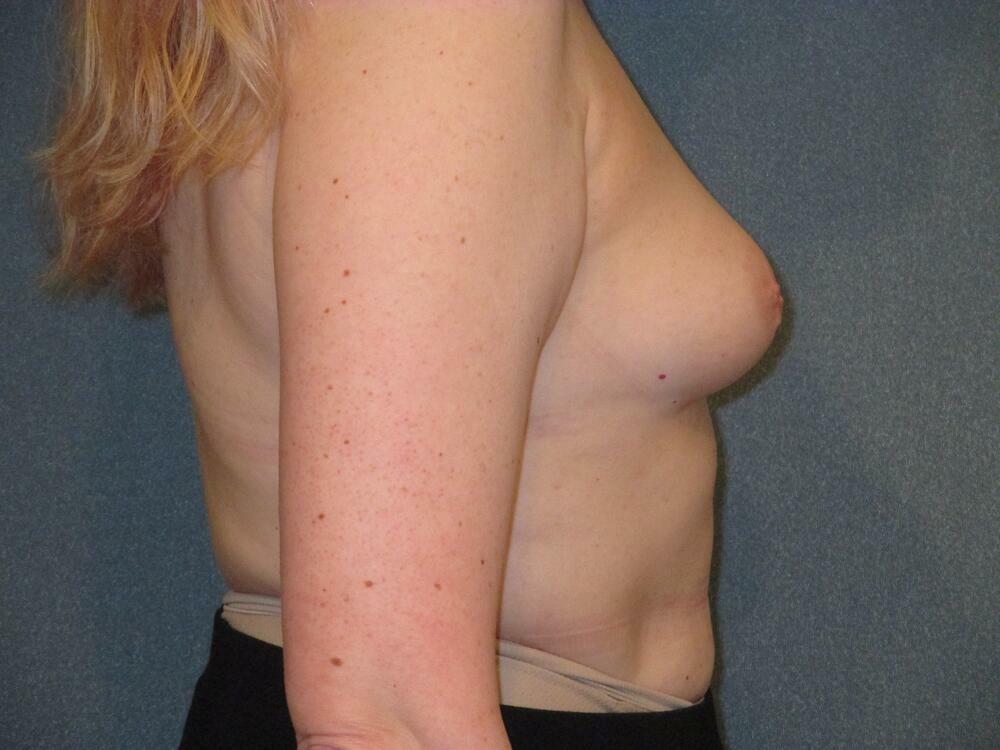 Breast Augmentation Before & After