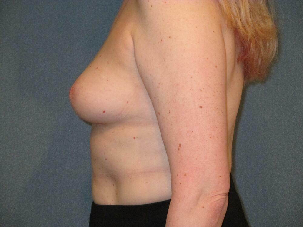 Breast Augmentation Before & After