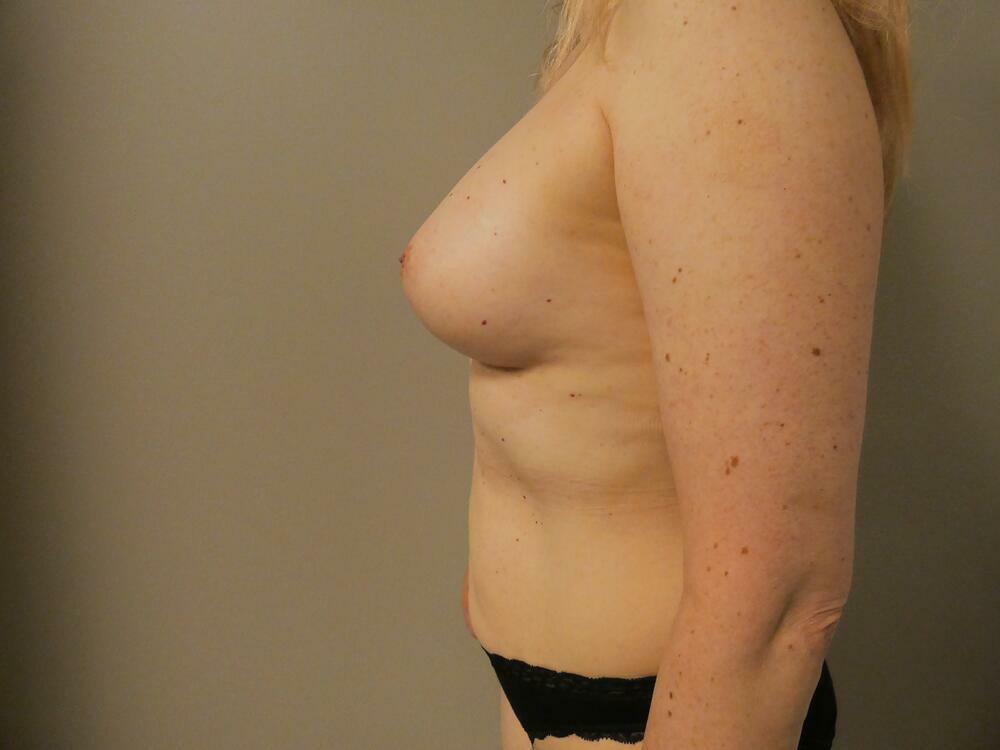 Breast Augmentation Before & After