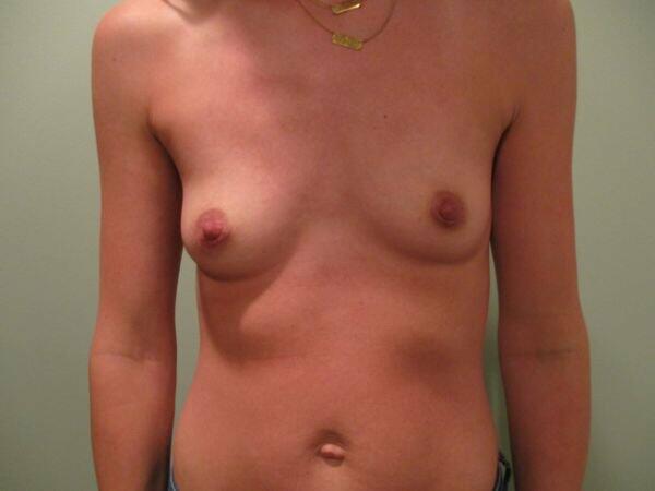 Breast Augmentation Before & After